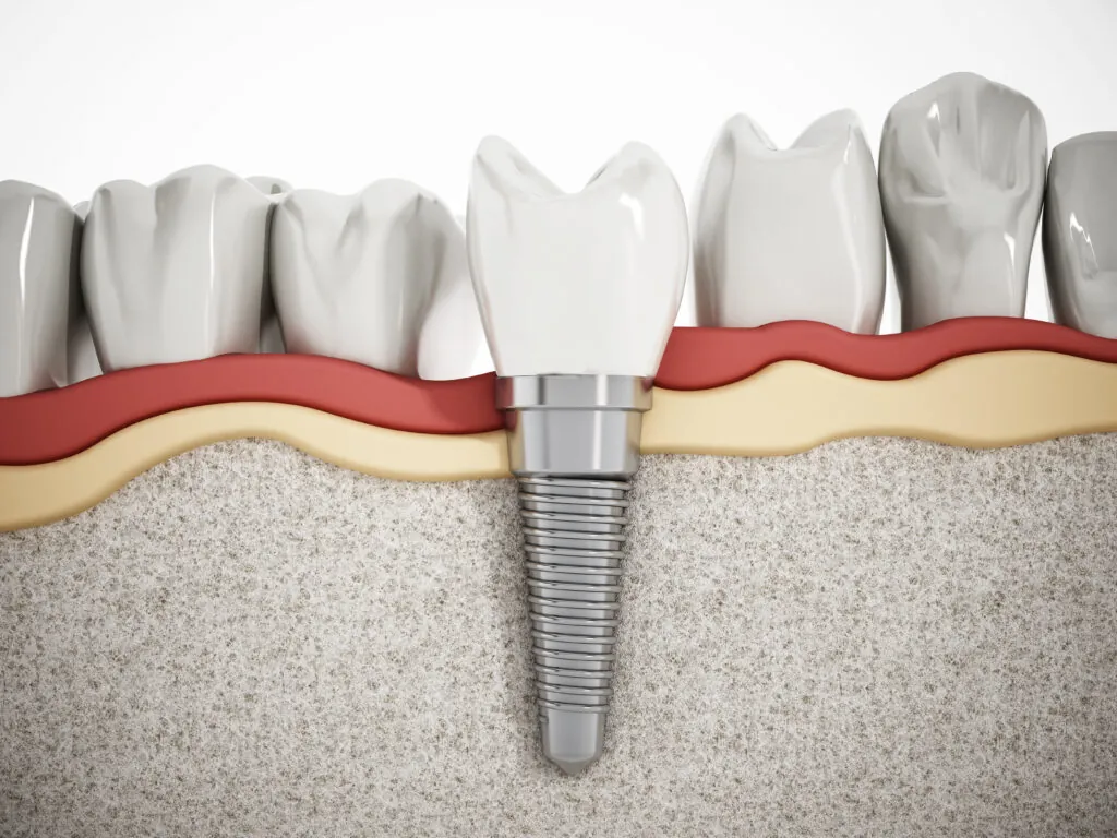 Image showing how dental implants fit into the jaw in between natural teeth.